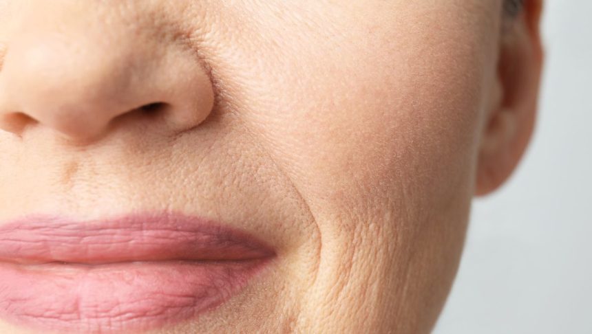 The woman has lip wrinkles.
